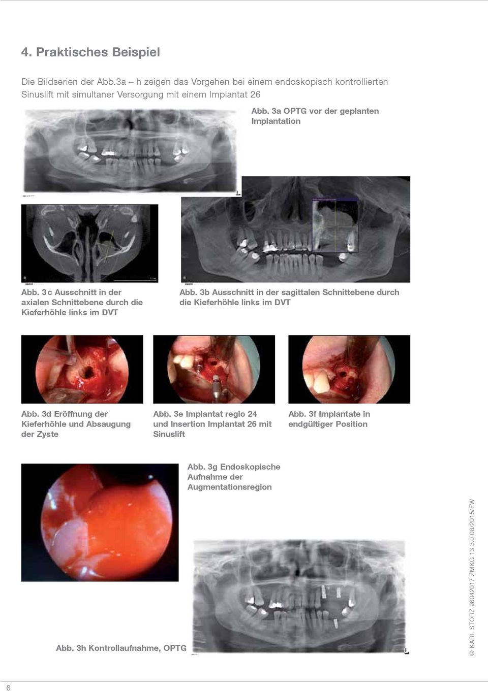 3a OPTG vor der geplanten Implantation Abb. 3 c Ausschnitt in der axialen Schnittebene durch die Kieferhöhle links im DVT Abb.