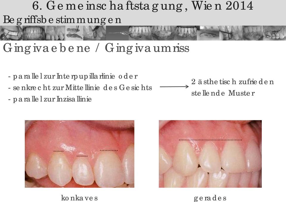 Mittellinie des Gesichts - parallel zur Inzisallinie