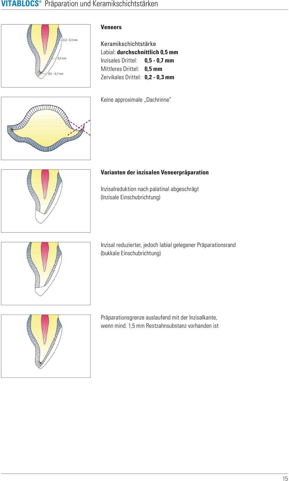 Veneerpräparation Inzisalreduktion nach palatinal abgeschrägt (Inzisale Einschubrichtung) Inzisal reduzierter, jedoch labial gelegener