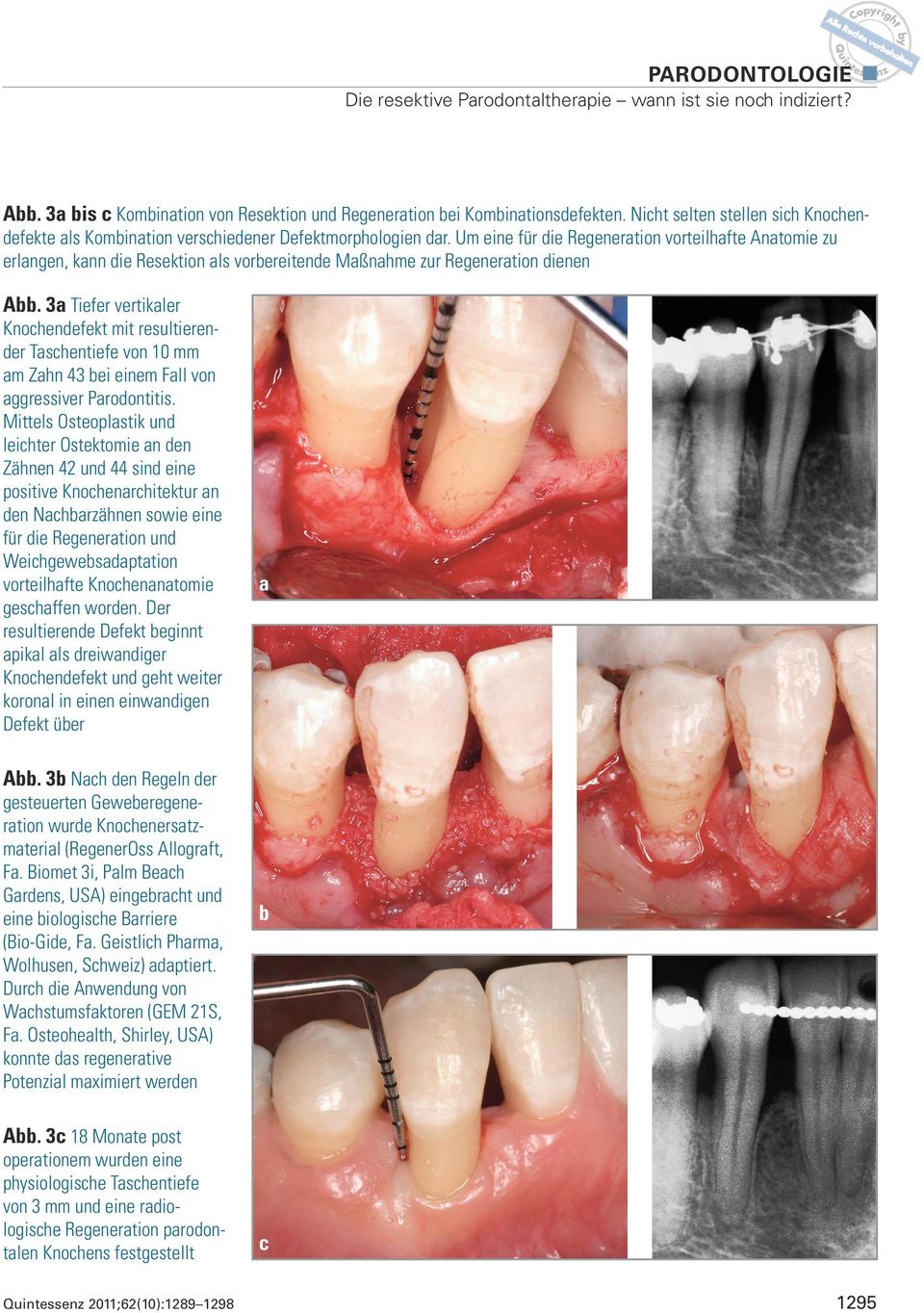 3a Tiefer vertikaler Knochendefekt mit resultierender Taschentiefe von 10 mm am Zahn 43 bei einem Fall von aggressiver Parodontitis.