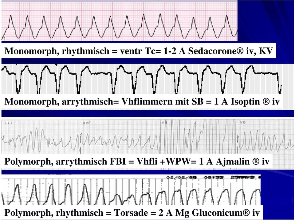 Isoptin iv Polymorph, arrythmisch FBI = Vhfli +WPW= 1 A
