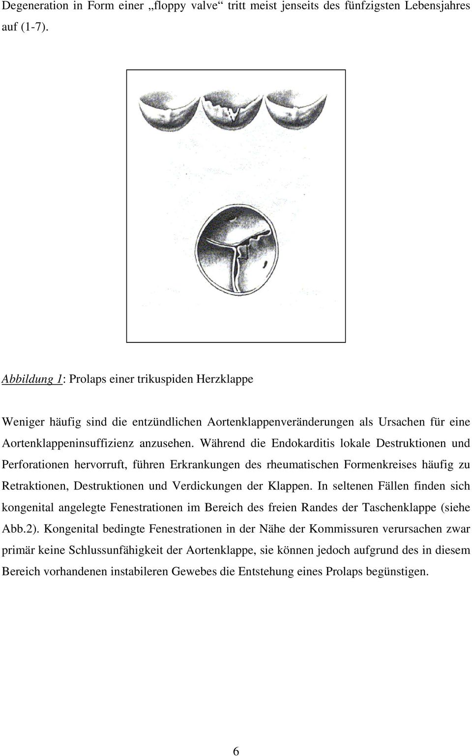 Während die Endokarditis lokale Destruktionen und Perforationen hervorruft, führen Erkrankungen des rheumatischen Formenkreises häufig zu Retraktionen, Destruktionen und Verdickungen der Klappen.