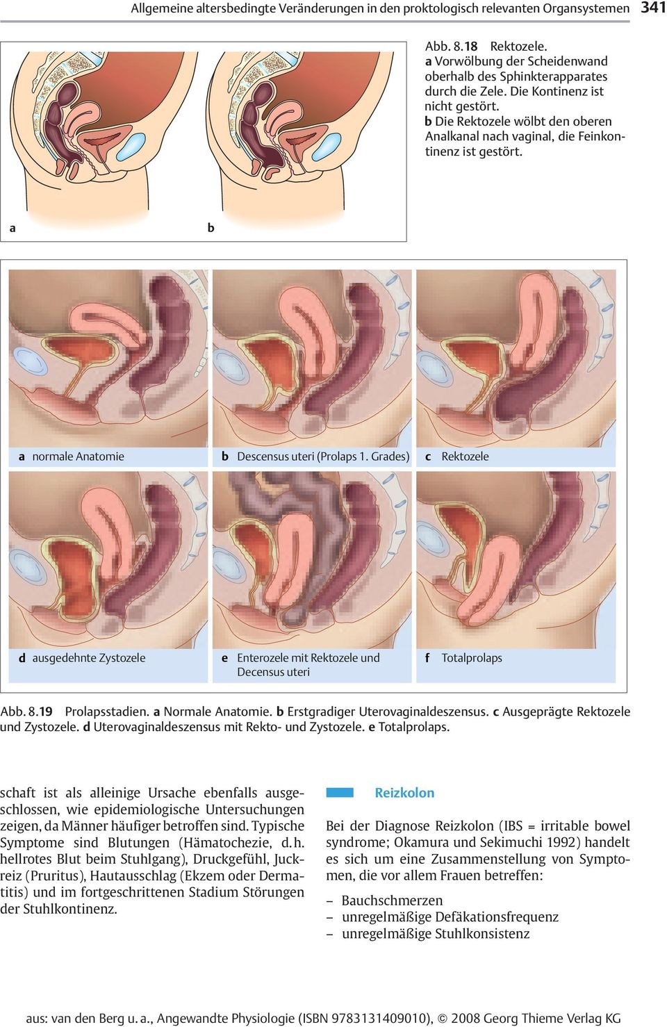 Grades) c Rektozele d ausgedehnte Zystozele e Enterozele mit Rektozele und Decensus uteri f Totalprolaps Abb. 8.19 Prolapsstadien. a Normale Anatomie. b Erstgradiger Uterovaginaldeszensus.
