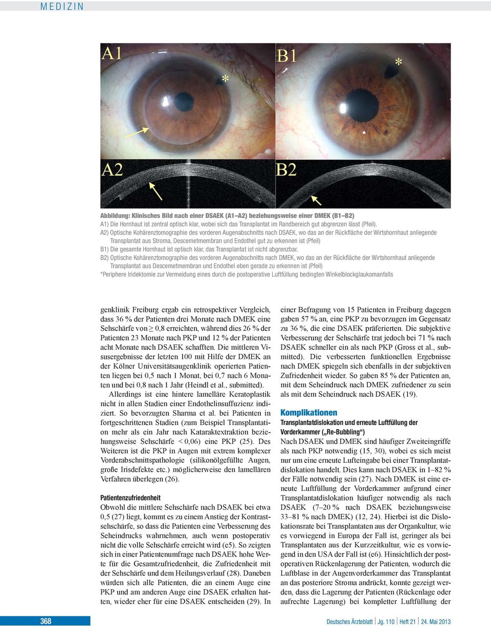 A2) Optische Kohärenztomographie des vorderen Augenabschnitts nach DSAEK, wo das an der Rückfläche der Wirtshornhaut anliegende Transplantat aus Stroma, Descemetmembran und Endothel gut zu erkennen