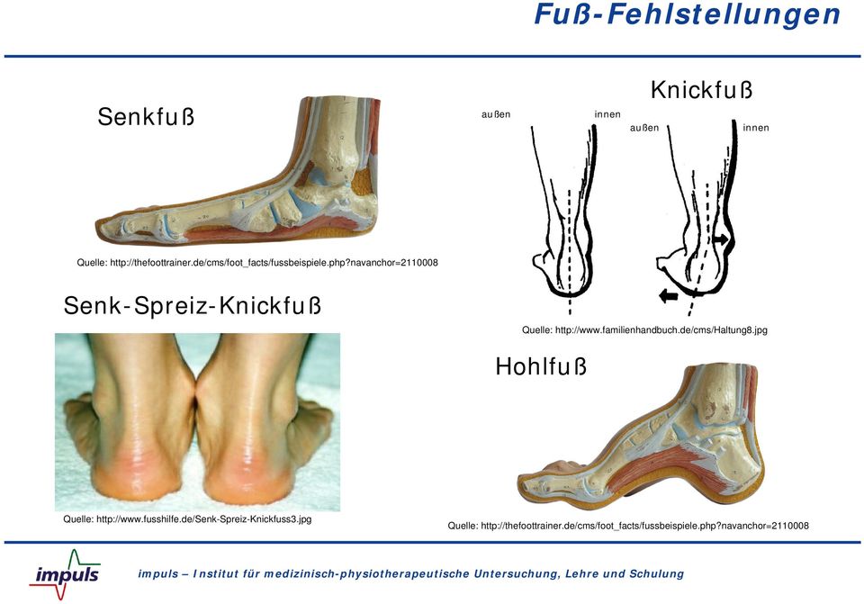 navanchor=2110008 Senk-Spreiz-Knickfuß Quelle: http://www.familienhandbuch.de/cms/haltung8.