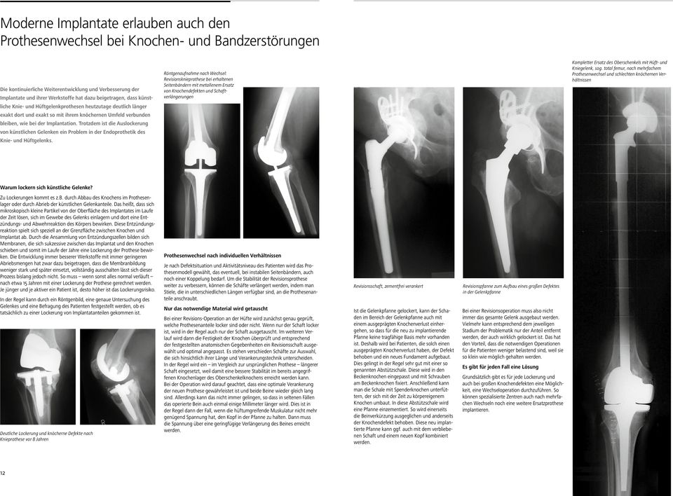 Trotzdem ist die Auslockerung von künstlichen Gelenken ein Problem in der Endoprothetik des Knie- und Hüftgelenks.