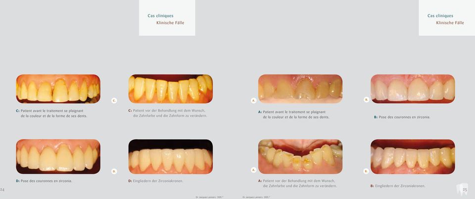 A: Patient avant le traitement se plaignant de la couleur et de la forme de ses dents. B: Pose des couronnes en zirconia. D.