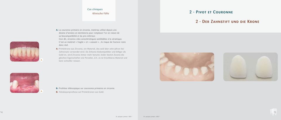 A: Primärkrone aus Zirconia, ein Material, das seid über zehn Jahren bei Zahnersatz verwendet wird.