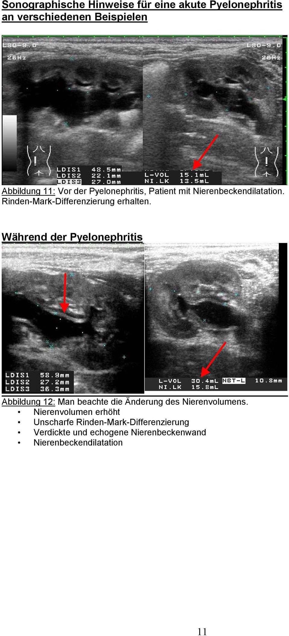 Während der Pyelonephritis Abbildung 12: Man beachte die Änderung des Nierenvolumens.