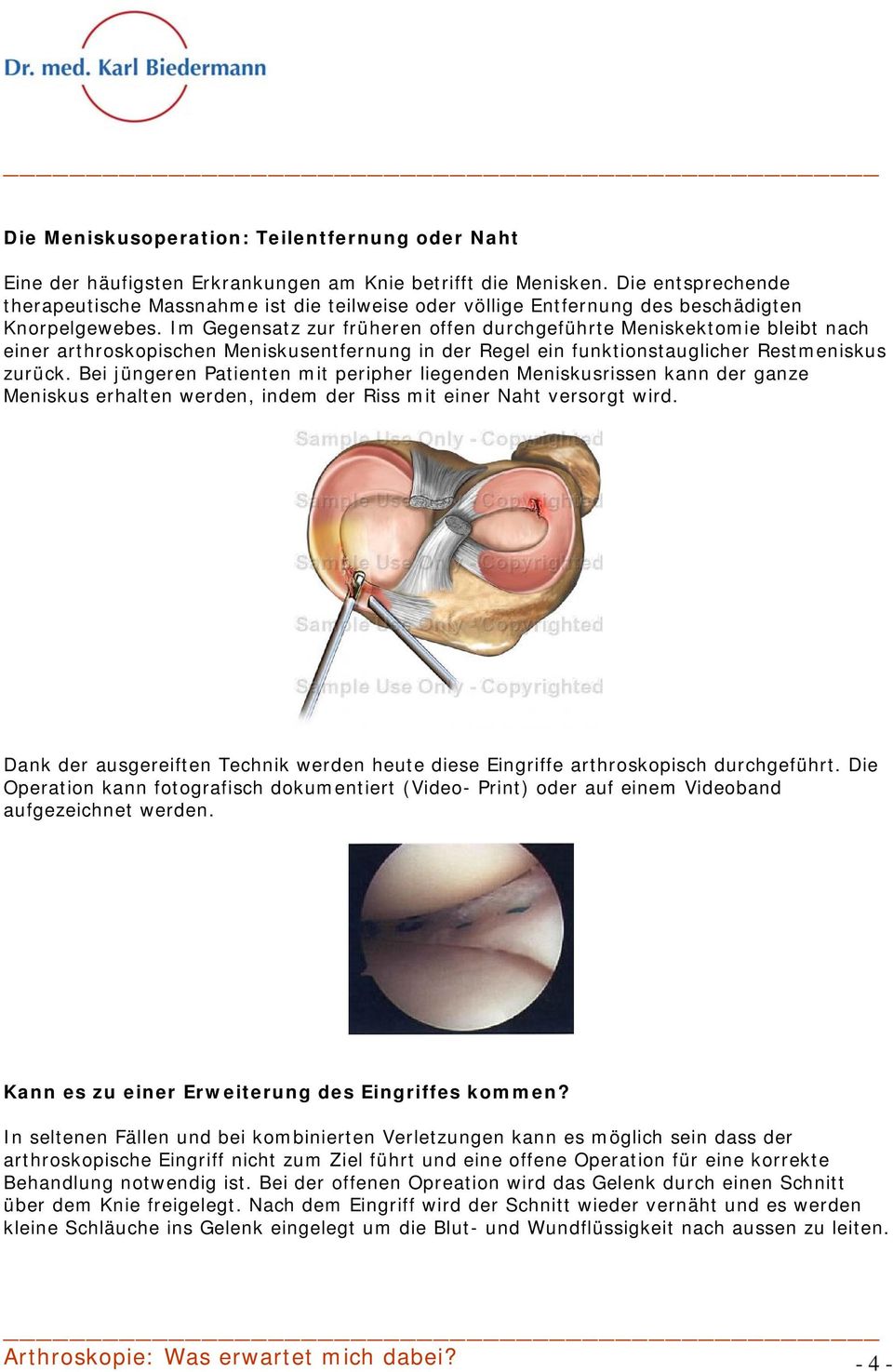 Im Gegensatz zur früheren offen durchgeführte Meniskektomie bleibt nach einer arthroskopischen Meniskusentfernung in der Regel ein funktionstauglicher Restmeniskus zurück.