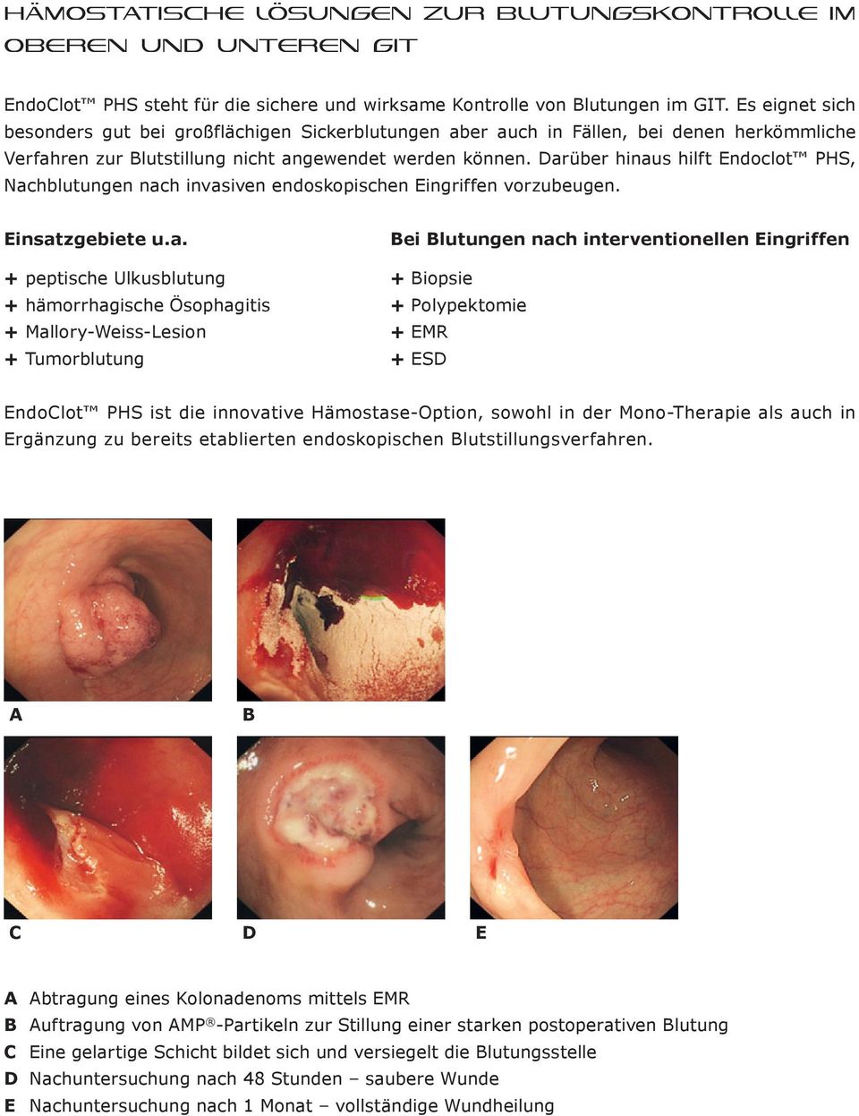 Darüber hinaus hilft Endoclot PHS, Nachblutungen nach invasiven endoskopischen Eingriffen vorzubeugen. Einsatzgebiete u.a. Bei Blutungen nach interventionellen Eingriffen + peptische Ulkusblutung +