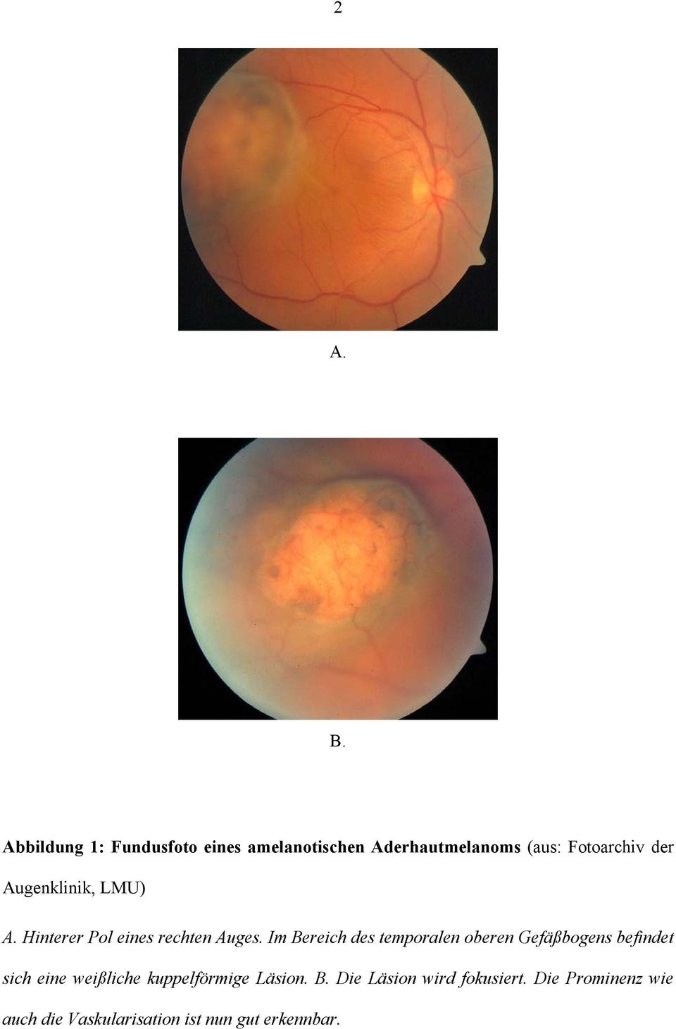Augenklinik, LMU) A. Hinterer Pol eines rechten Auges.