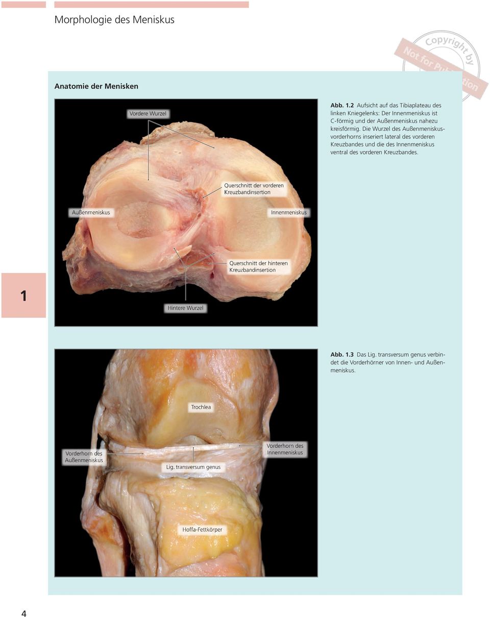 Die Wurzel des Außenmeniskusvorderhorns inseriert lateral des vorderen reuzbandes und die des Innenmeniskus ventral des vorderen reuzbandes.