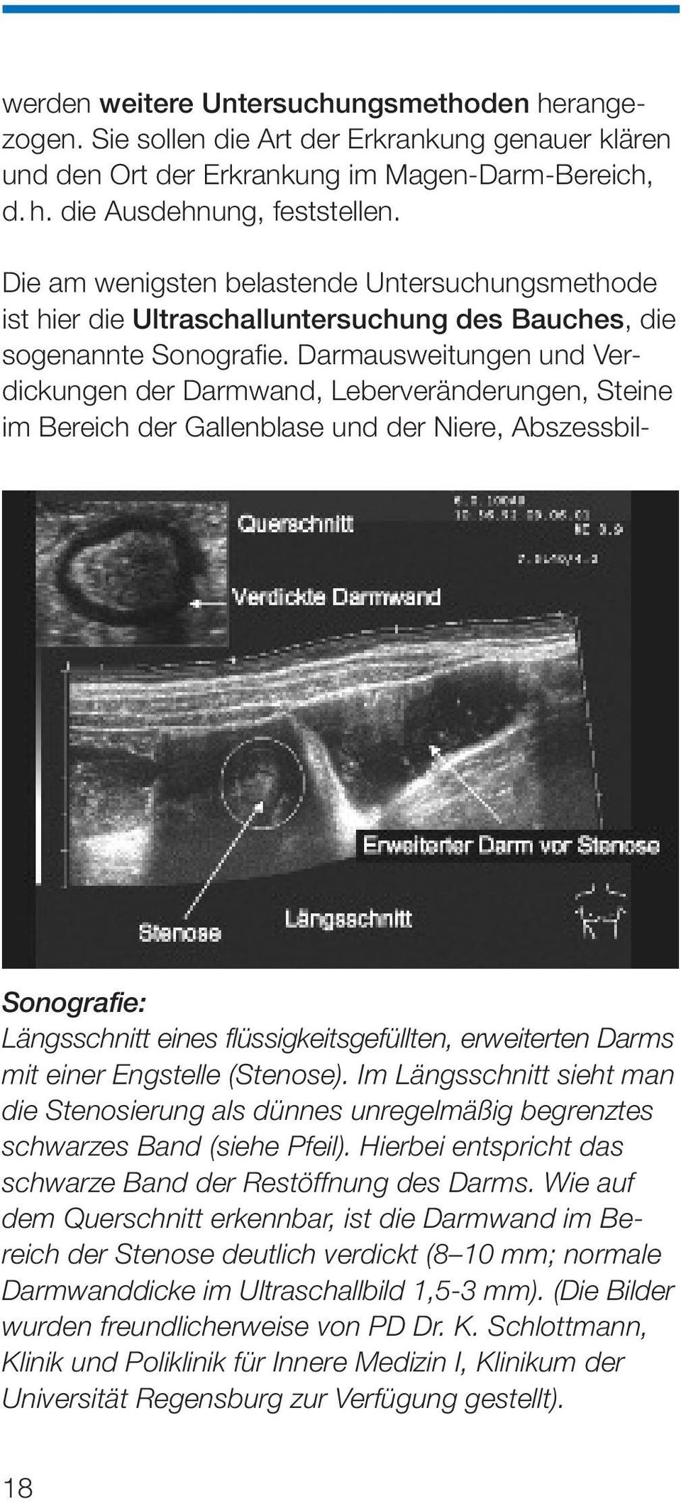 Darmausweitungen und Verdickungen der Darmwand, Leberveränderungen, Steine im Bereich der Gallenblase und der Niere, Abszessbil- Sonografie: Längsschnitt eines flüssigkeitsgefüllten, erweiterten