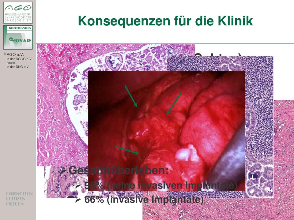 Lymphknotenbeteiligung (20%) peritoneale Implantate (20%) non invasiv