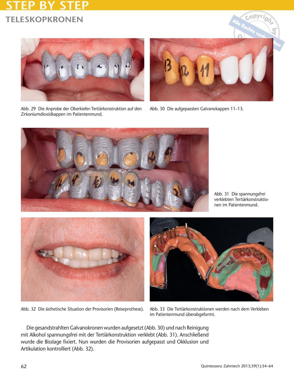 Die gesandstrahlten Galvanokronen wurden aufgesetzt (Abb. 30) und nach Reinigung mit Alkohol spannungsfrei mit der Tertiärkonstruktion verklebt (Abb. 31).