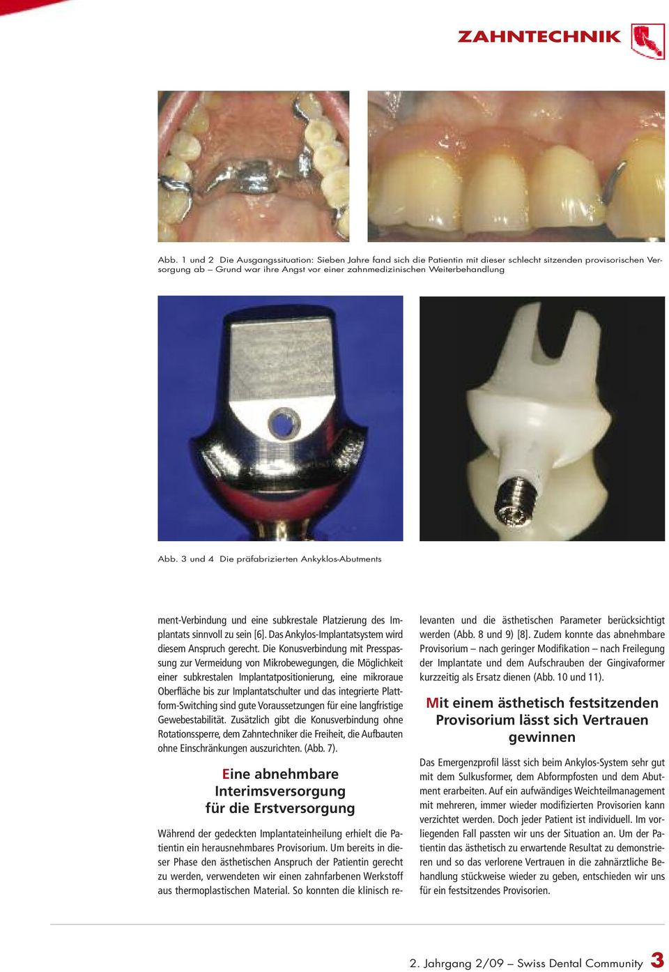 Die Konusverbindung mit Presspassung zur Vermeidung von Mikrobewegungen, die Möglichkeit einer subkrestalen Implantatpositionierung, eine mikroraue Oberfläche bis zur Implantatschulter und das