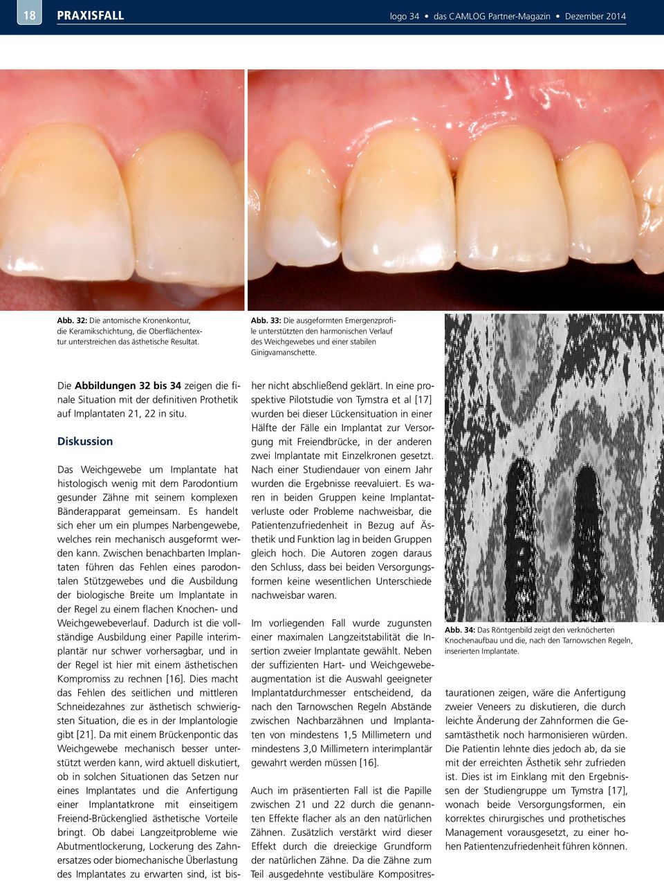 Diskussion Das Weichgewebe um Implantate hat histologisch wenig mit dem Parodontium gesunder Zähne mit seinem komplexen Bänderapparat gemeinsam.