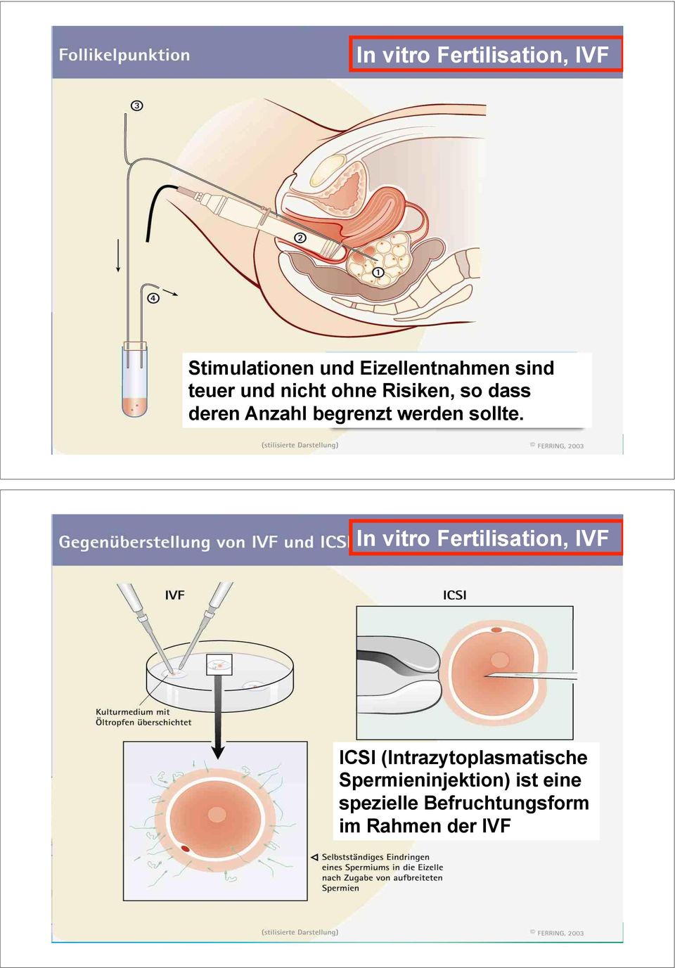 Michael von Wolff 15 In vitro Fertilisation, IVF ICSI (Intrazytoplasmatische