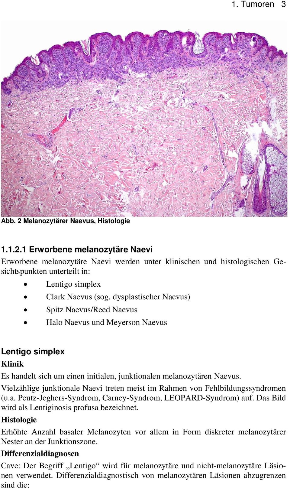 Vielzählige junktionale Naevi treten meist im Rahmen von Fehlbildungssyndromen (u.a. Peutz-Jeghers-Syndrom, Carney-Syndrom, LEOPARD-Syndrom) auf. Das Bild wird als Lentiginosis profusa bezeichnet.
