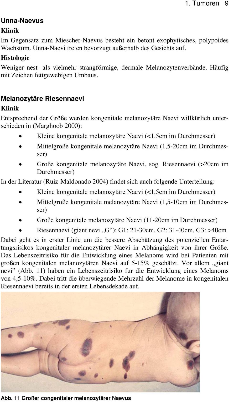 Melanozytäre Riesennaevi Entsprechend der Größe werden kongenitale melanozytäre Naevi willkürlich unterschieden in (Marghoob 2000): Kleine kongenitale melanozytäre Naevi (<1,5cm im Durchmesser)