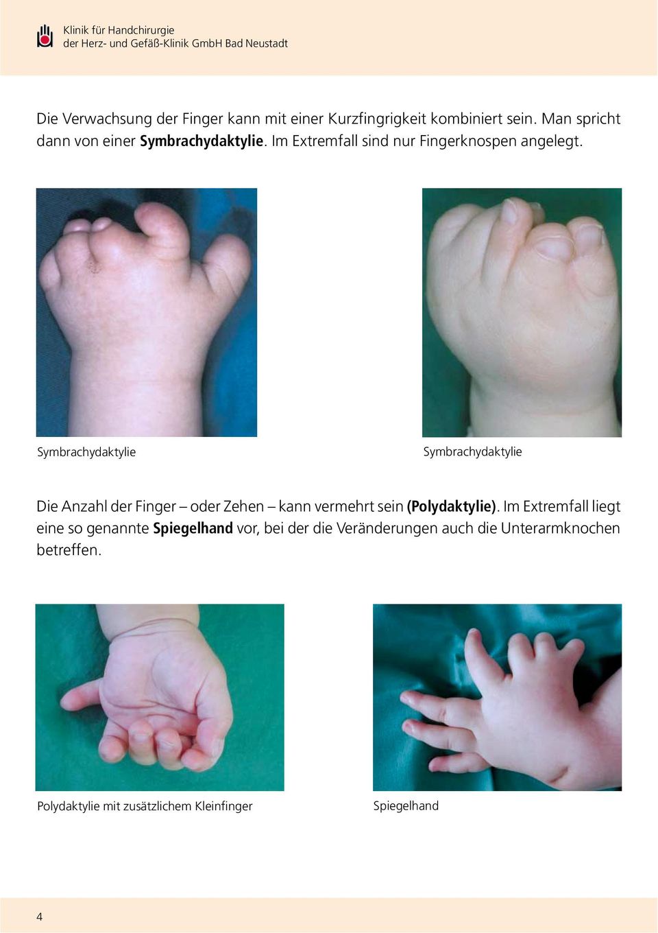 Symbrachydaktylie Symbrachydaktylie Die Anzahl der Finger oder Zehen kann vermehrt sein (Polydaktylie).