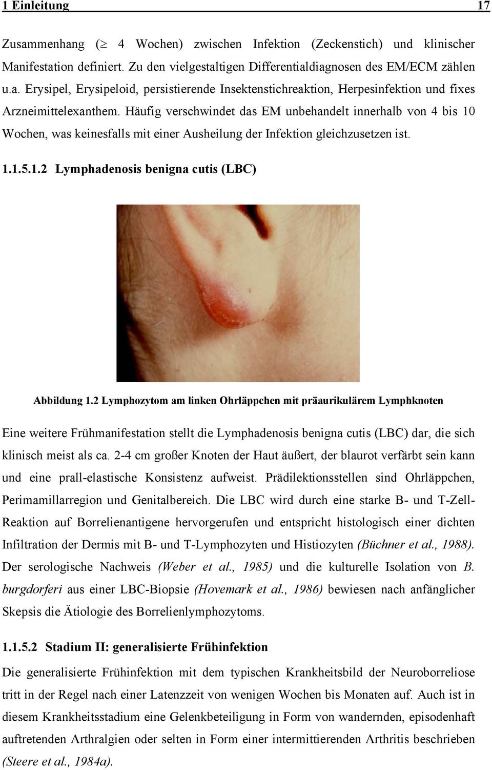 2 Lymphozytom am linken Ohrläppchen mit präaurikulärem Lymphknoten Eine weitere Frühmanifestation stellt die Lymphadenosis benigna cutis (LBC) dar, die sich klinisch meist als ca.