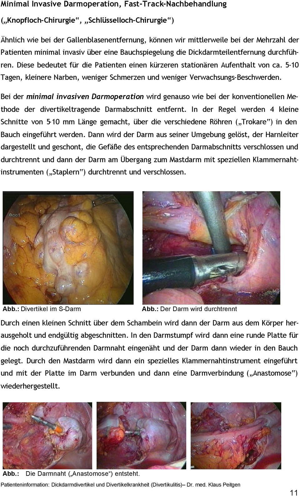 5-10 Tagen, kleinere Narben, weniger Schmerzen und weniger Verwachsungs-Beschwerden.