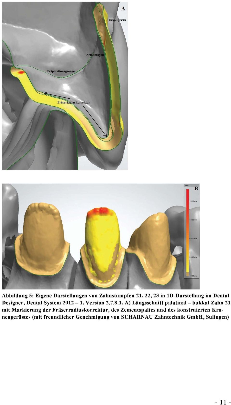 1, A) Längsschnitt palatinal bukkal Zahn 21 mit Markierung der Fräserradiuskorrektur,