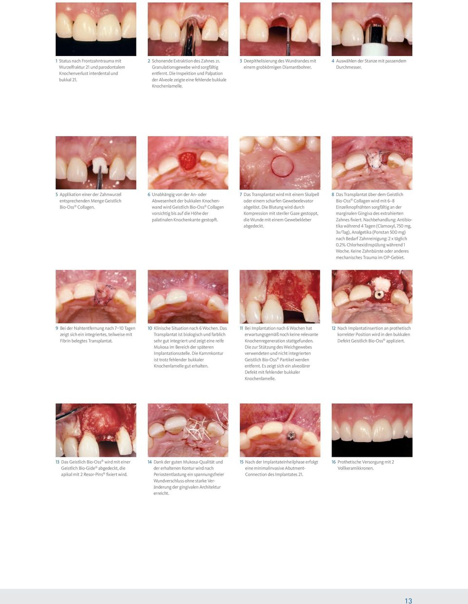 4 Auswählen der Stanze mit passendem Durchmesser. 5 Applikation einer der Zahnwurzel entsprechenden Menge Geistlich Bio-Oss Collagen.