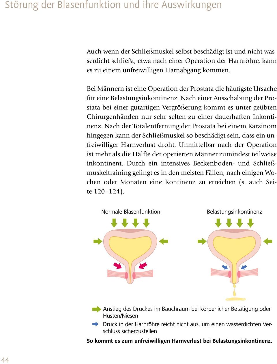 Nach einer Ausschabung der Prostata bei einer gutartigen Vergrößerung kommt es unter geübten Chirurgenhänden nur sehr selten zu einer dauerhaften Inkontinenz.