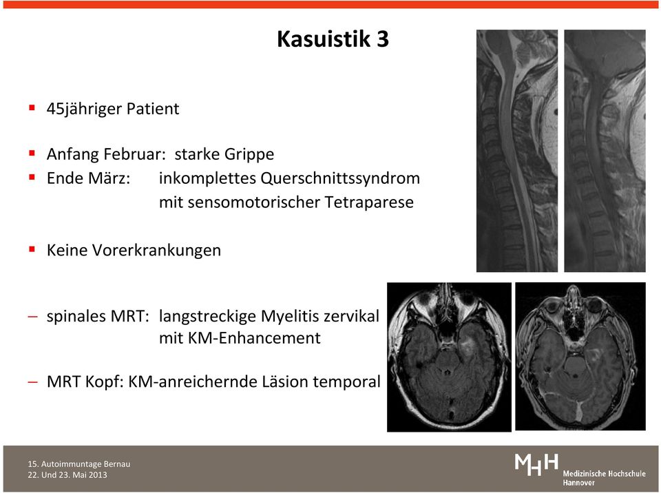 Tetraparese Keine Vorerkrankungen spinales MRT: langstreckige
