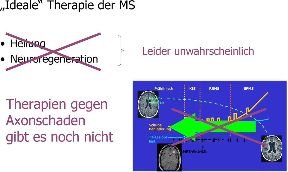 Therapien gegen Axonschaden gibt es noch nicht