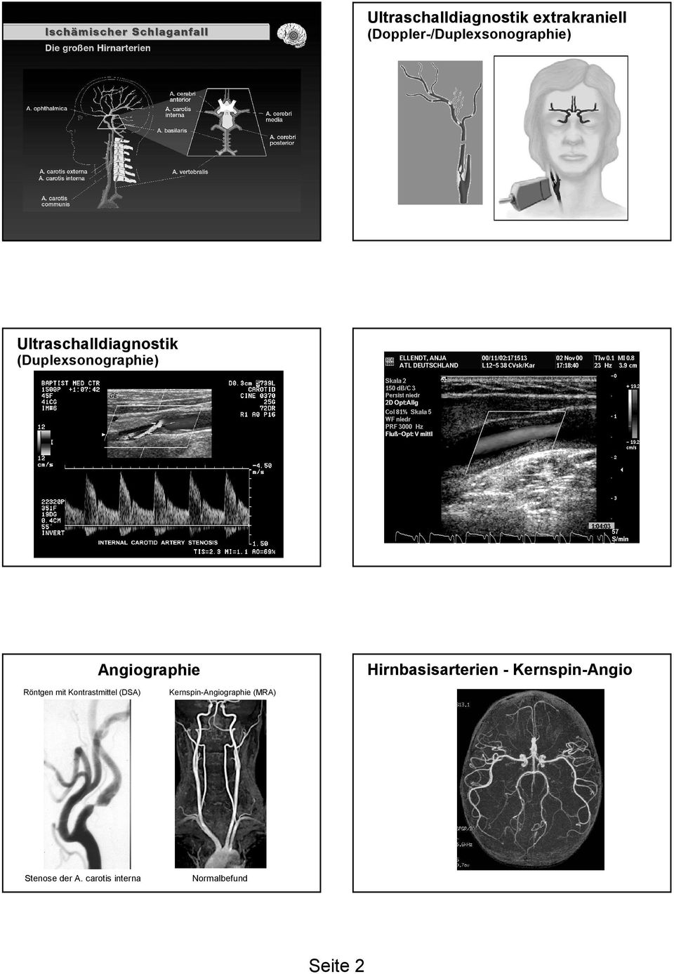 Hirnbasisarterien - KernspinKernspin-Angio Angiographie Röntgen mit