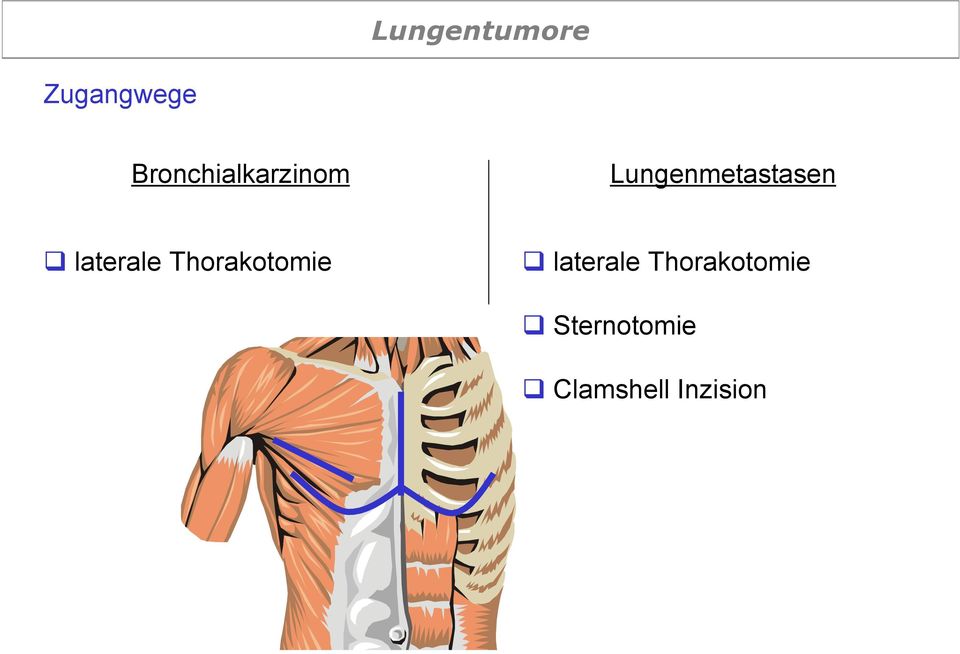 Thorakotomie laterale