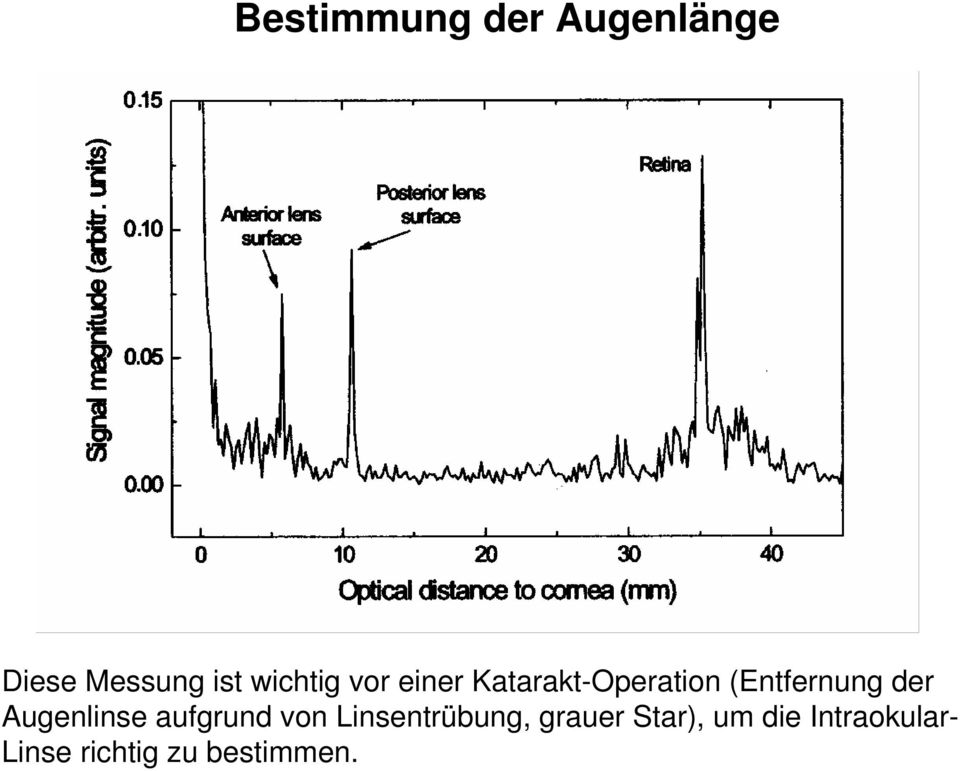 der Augenlinse aufgrund von Linsentrübung, grauer