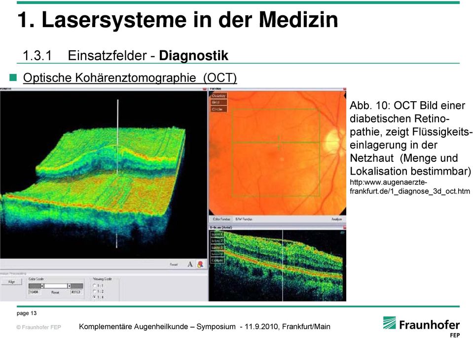 10: OCT Bild einer diabetischen Retinopathie, zeigt