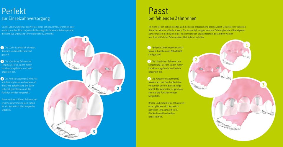 Die künstliche Zahnwurzel (Implantat) wird in den Kieferknochen eingebracht und heilt ungestört ein.