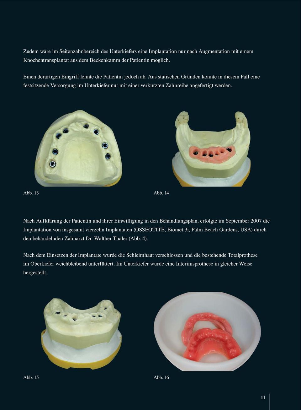 Aus statischen Gründen konnte in diesem Fall eine festsitzende Versorgung im Unterkiefer nur mit einer verkürzten Zahnreihe angefertigt werden. Abb. 13 Abb.