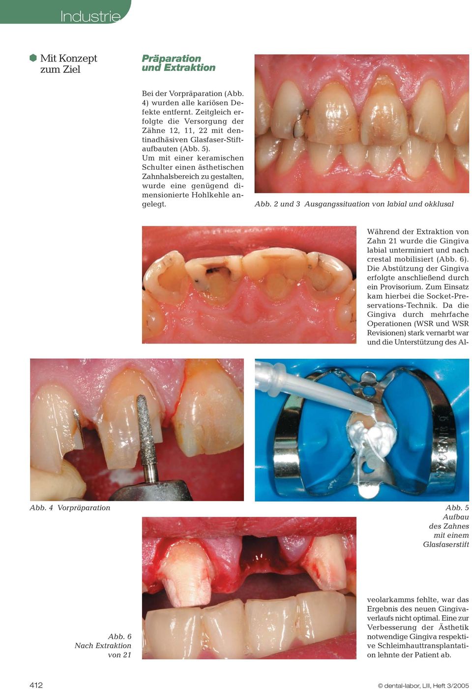 Um mit einer keramischen Schulter einen ästhetischen Zahnhalsbereich zu gestalten, wurde eine genügend dimensionierte Hohlkehle angelegt. Abb. 2 und 3 Ausgangssituation von labial und okklusal Abb.