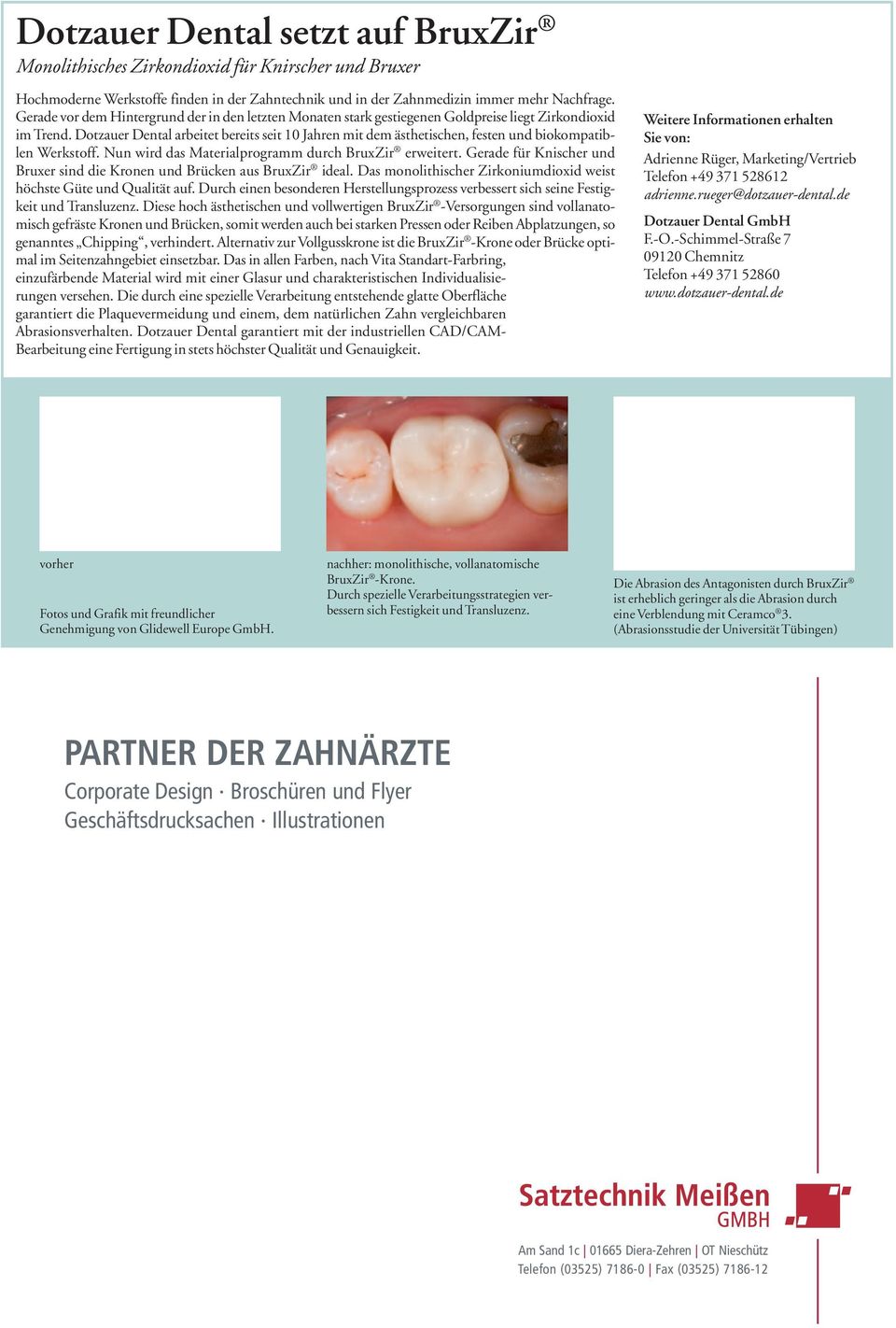 Dotzauer Dental arbeitet bereits seit 10 Jahren mit dem ästhetischen, festen und biokompatib - len Werkstoff. Nun wird das Materialprogramm durch BruxZir erweitert.