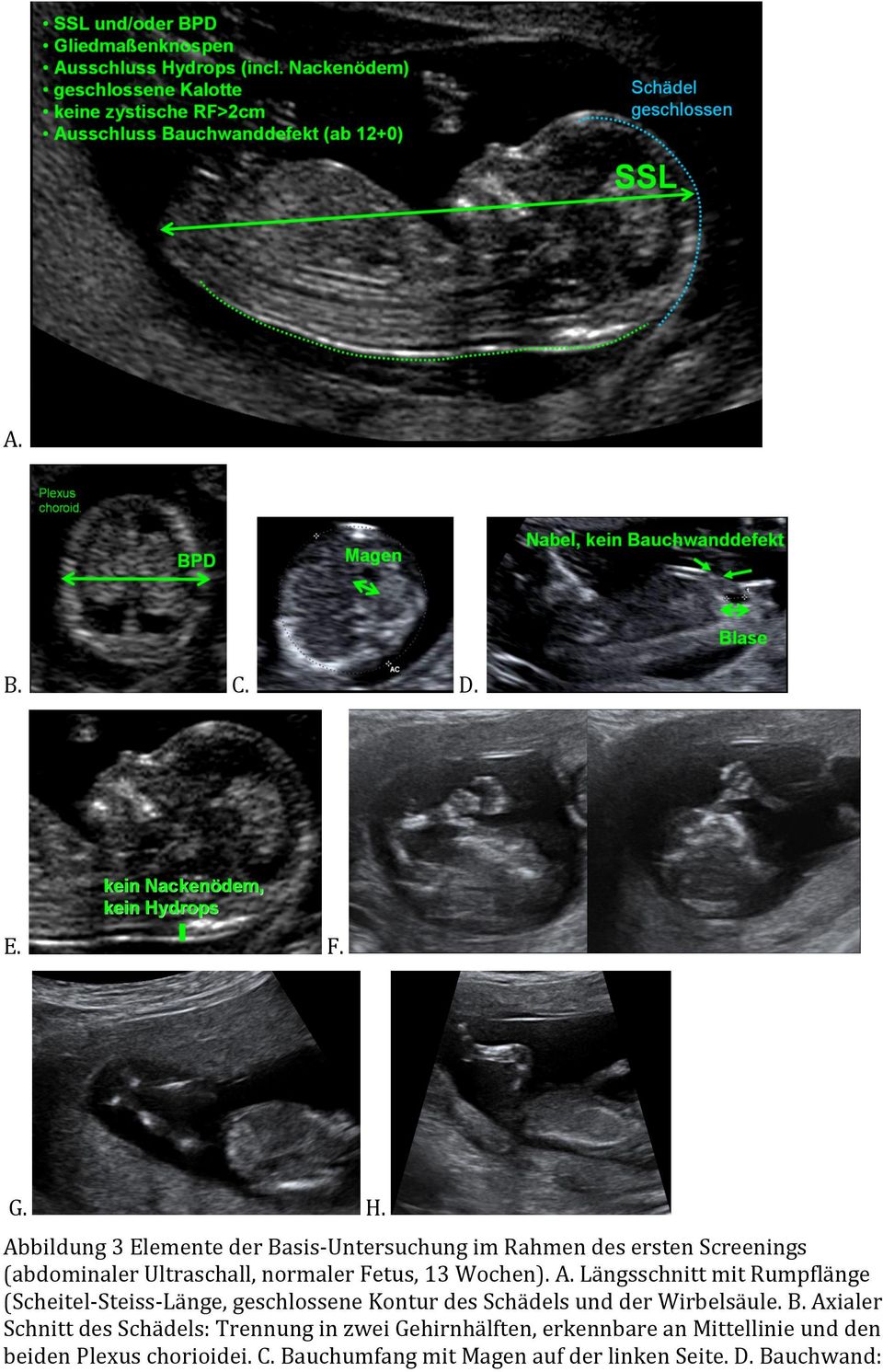 Fetus, 13 Wochen). A.
