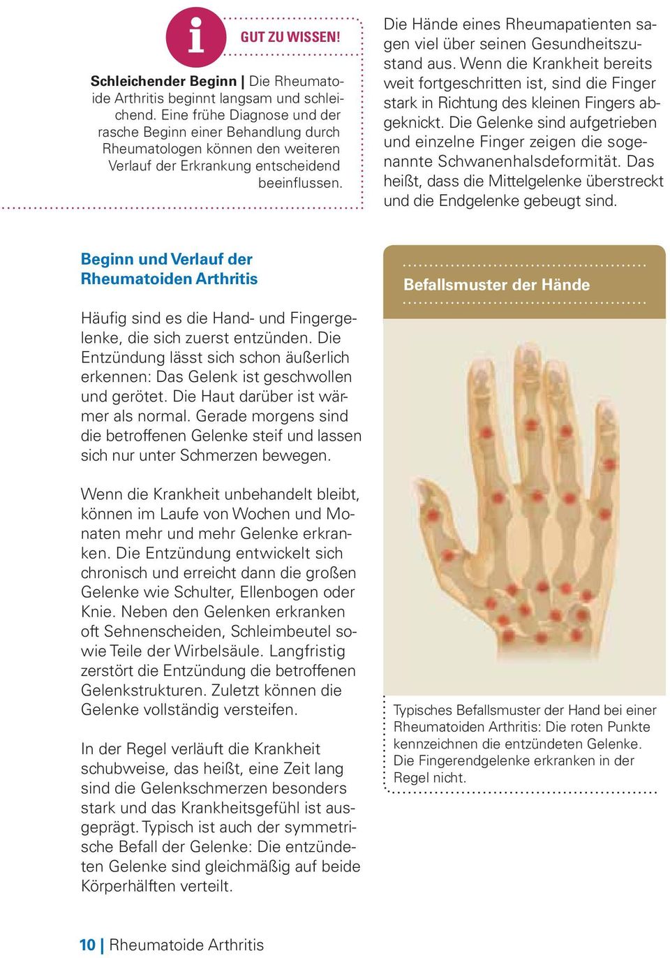 Die Hände eines Rheumapatienten sagen viel über seinen Gesundheitszustand aus. Wenn die Krankheit bereits weit fortgeschritten ist, sind die Finger stark in Richtung des kleinen Fingers abgeknickt.