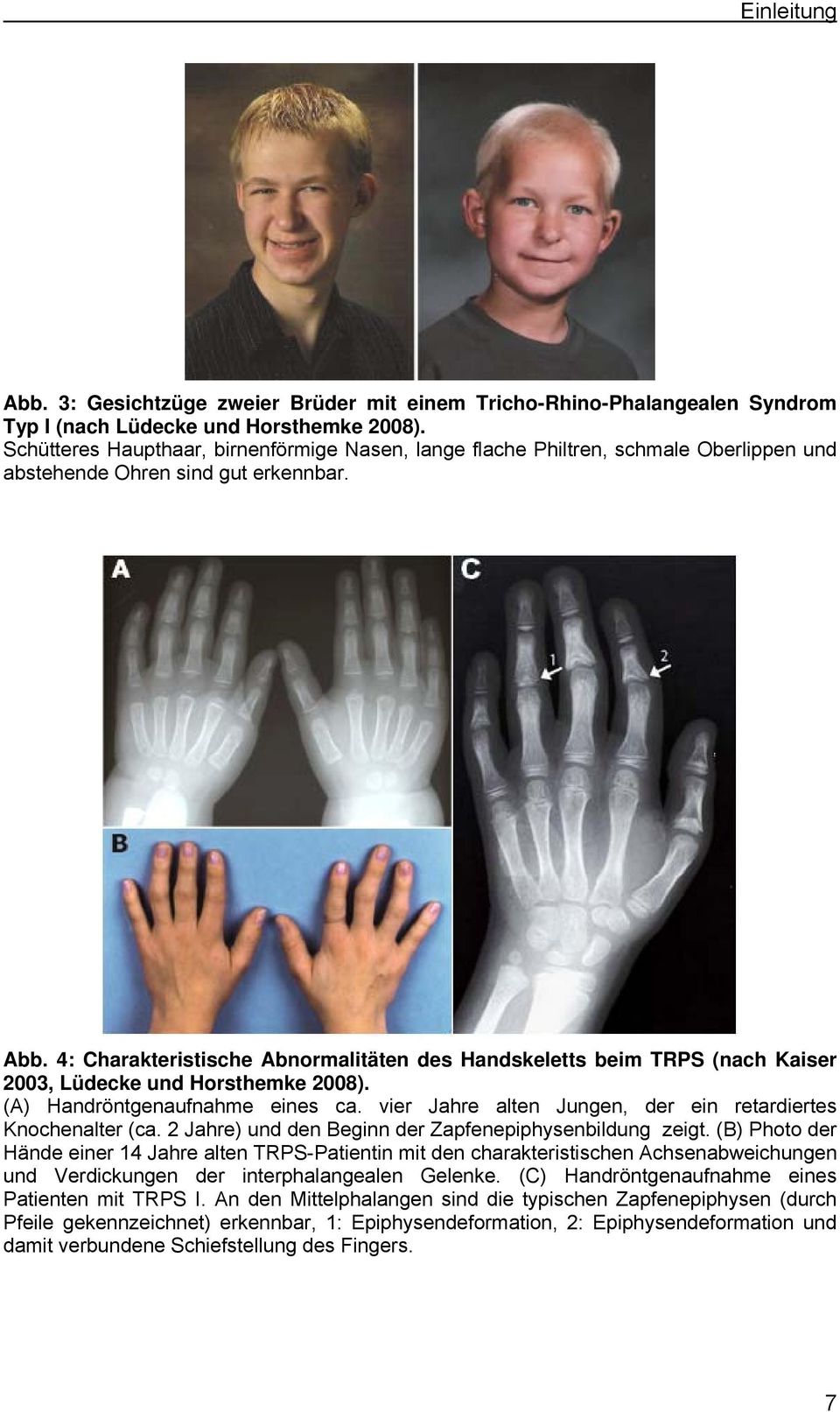 4: Charakteristische Abnormalitäten des Handskeletts beim TRPS (nach Kaiser 2003, Lüdecke und Horsthemke 2008). (A) Handröntgenaufnahme eines ca.
