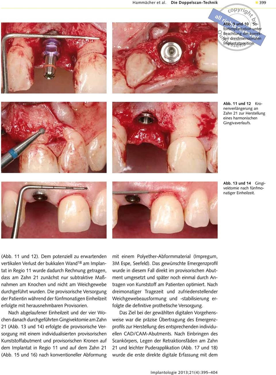 Dem potenziell zu erwartenden vertikalen Verlust der bukkalen Wand 18 am Implantat in Regio 11 wurde dadurch Rechnung getragen, dass am Zahn 21 zunächst nur subtraktive Maßnahmen am Knochen und nicht