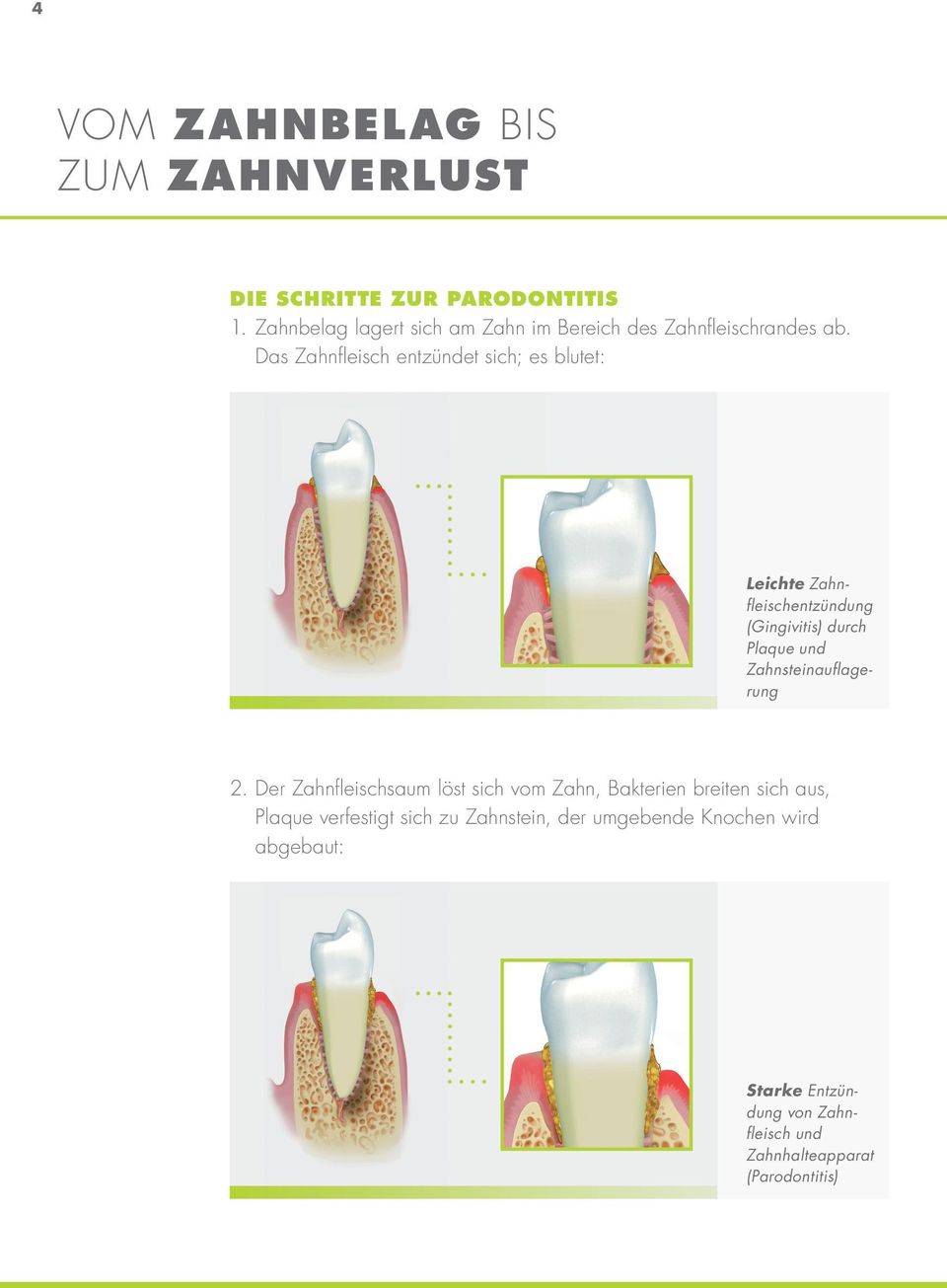 Das Zahnfleisch entzündet sich; es blutet: Leichte Zahnfleischentzündung (Gingivitis) durch Plaque und