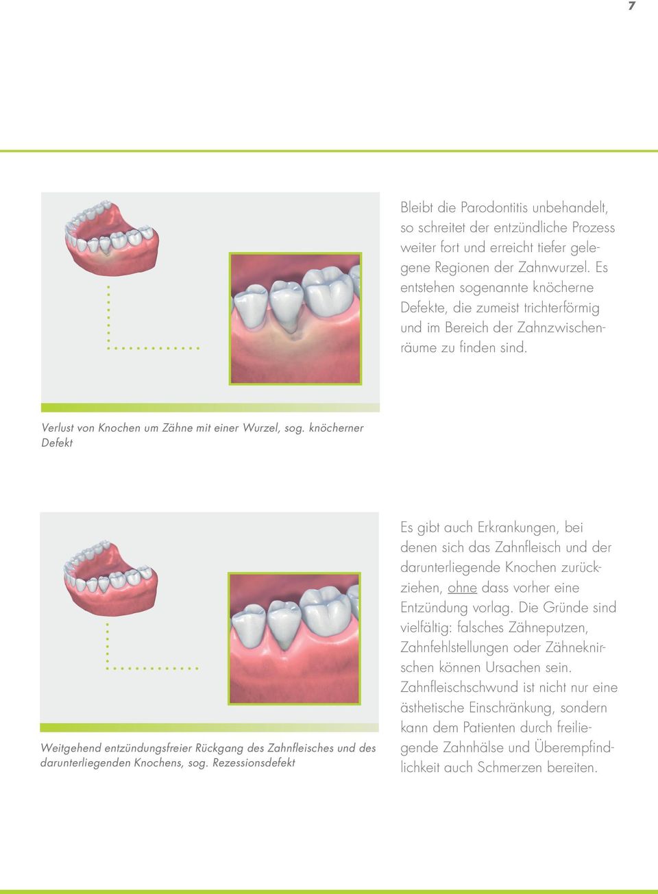 knöcherner Defekt Weitgehend entzündungsfreier Rückgang des Zahnfleisches und des darunterliegenden Knochens, sog.