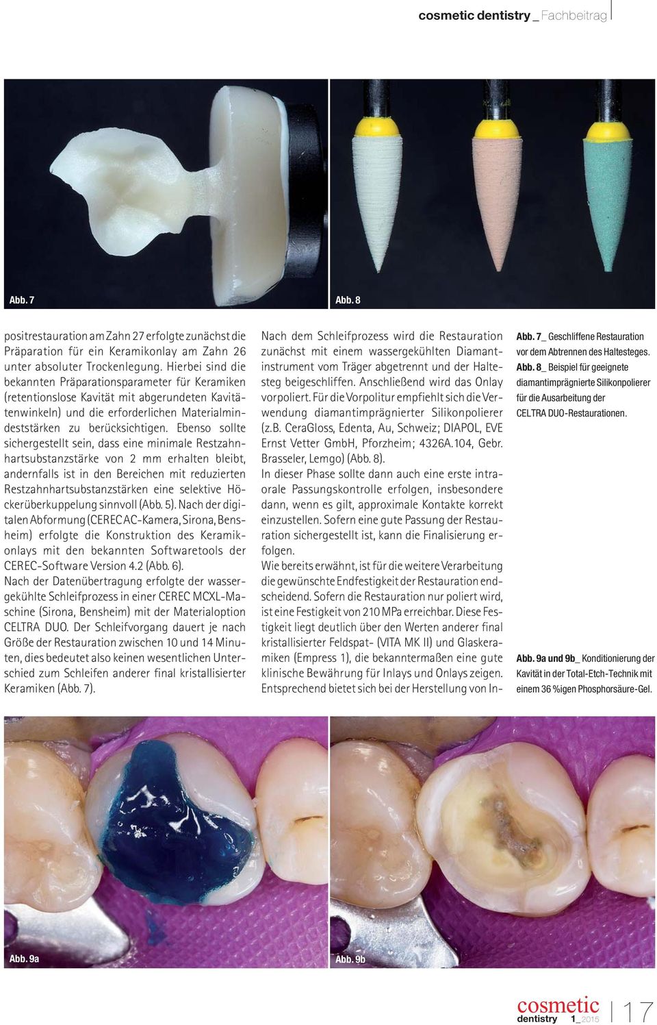 Ebenso sollte sichergestellt sein, dass eine minimale Restzahnhartsubstanzstärke von 2 mm erhalten bleibt, andernfalls ist in den Bereichen mit reduzierten Restzahnhartsubstanzstärken eine selektive