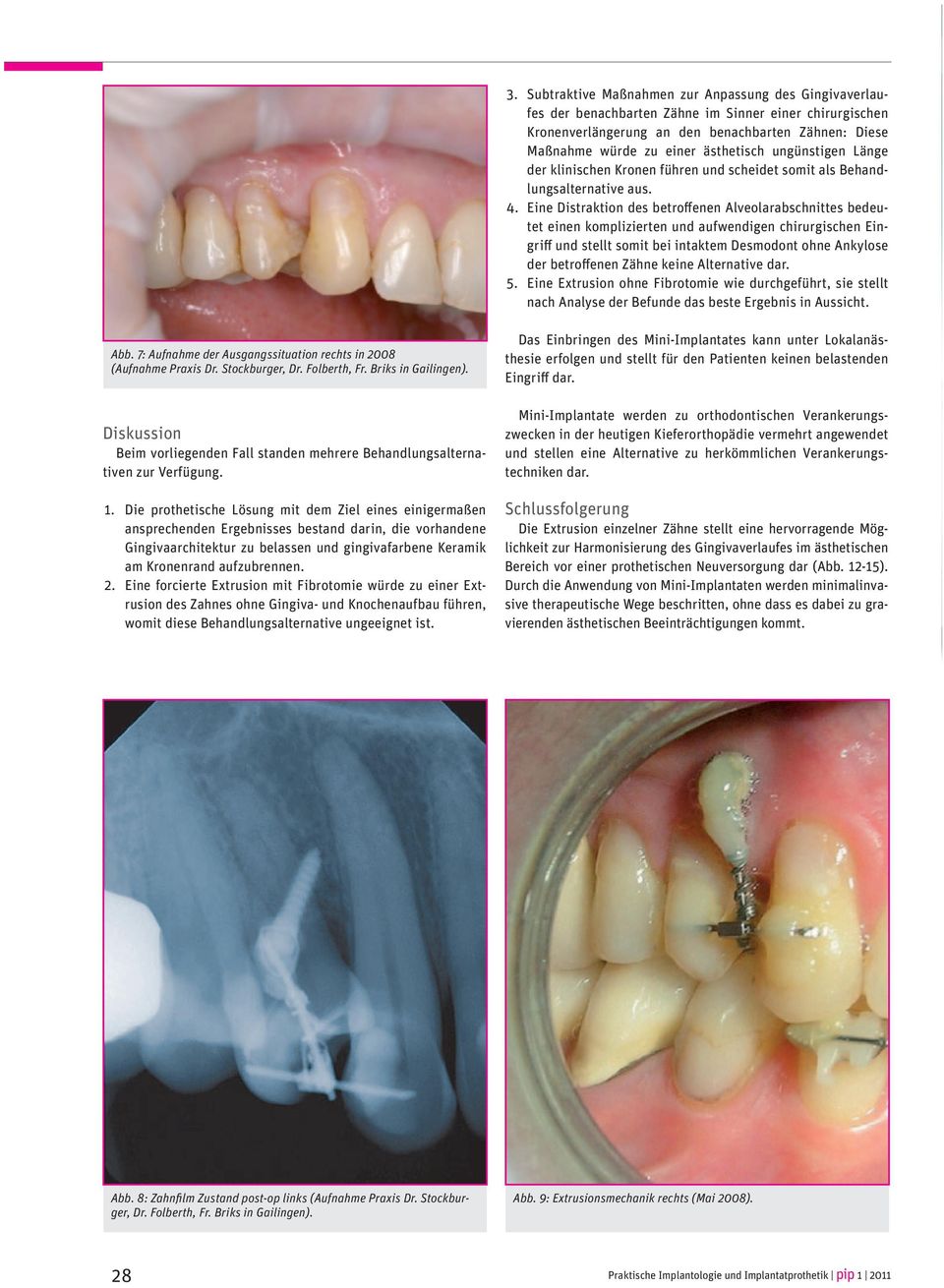 Eine Distraktion des betroffenen Alveolarabschnittes bedeutet einen komplizierten und aufwendigen chirurgischen Eingriff und stellt somit bei intaktem Desmodont ohne Ankylose der betroffenen Zähne