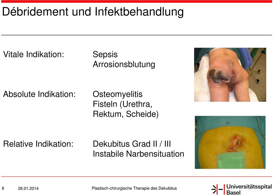 Osteomyelitis Fisteln (Urethra, Rektum, Scheide)